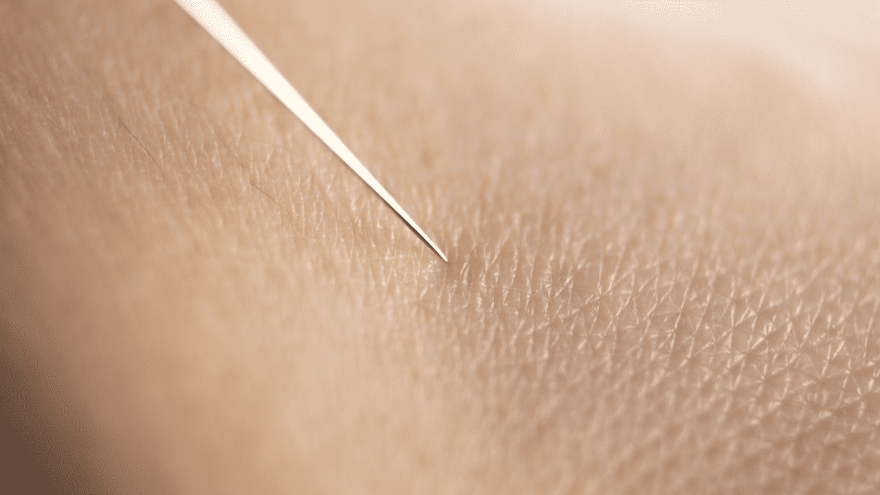 Dry Needling PainHero