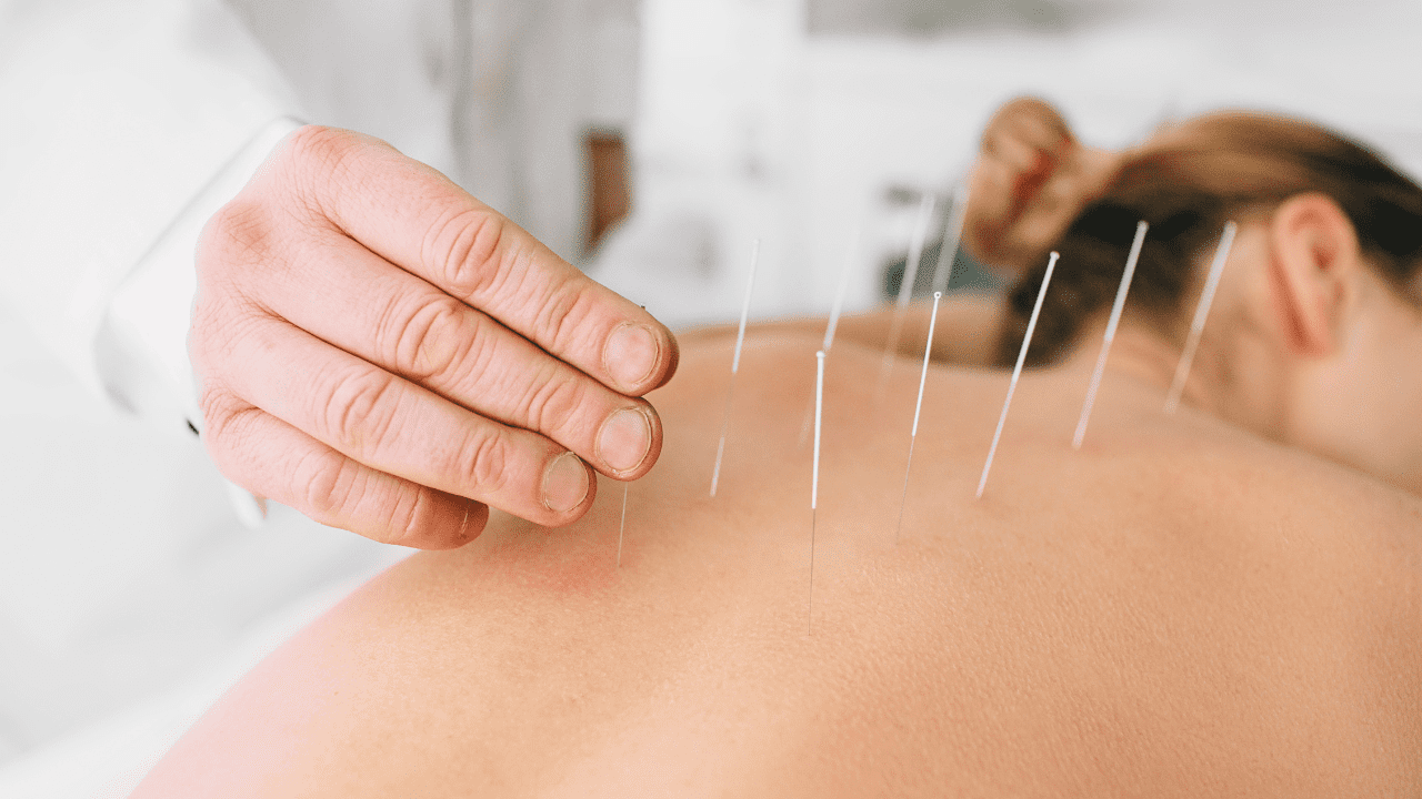 Acupuncture/Dry Needling Ian Shepard Physiotherapy Living Well