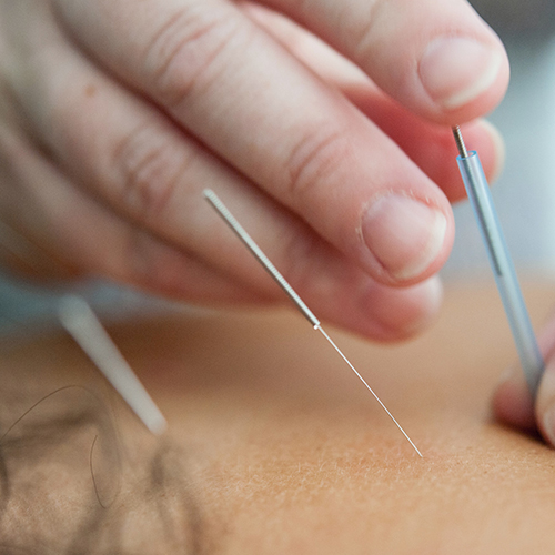 Acupuncture Optimum MacLeod Trail