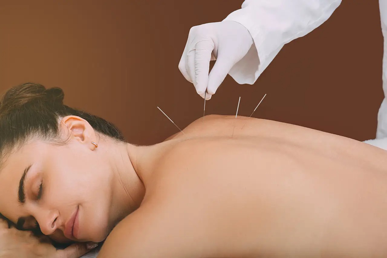 Acupuncture Orleans Physiotherapy PainHero acupuncture-orleans-physiotherapy-painhero