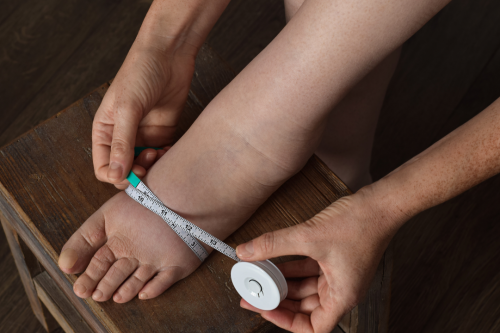 cornerstone physical therapy lymphedema