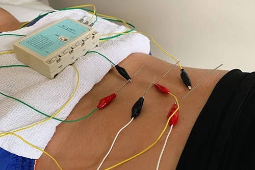 haldimand physiotherapy centre acupuncture