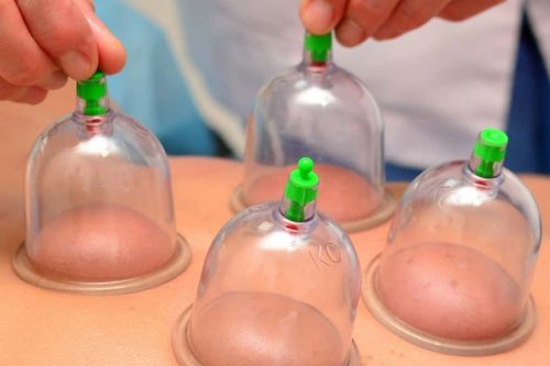 physiocare physiotherapy & rehab centre chinese cupping