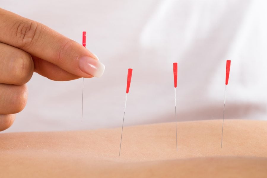 royal oak physio acupuncture